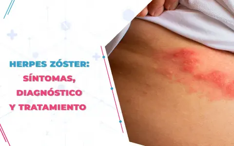 Herpes zóster: Medicamentos esenciales para evitar el dolor crónico