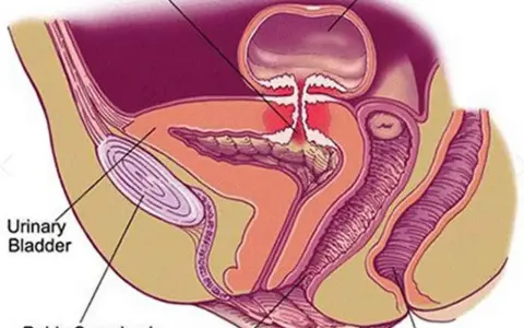 Anatomical diagram showing a colovesical fistula, a connection between the colon and bladder.
