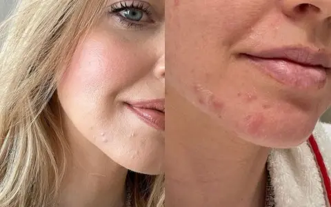 Viso con sfogo cutaneo, forse un'allergia. La pelle presenta rossori e piccole pustole, soprattutto intorno alla bocca e sul mento.
