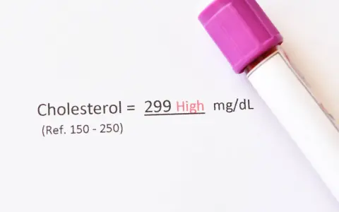 Wynik cholesterolu 299 mg/dL, co oznacza wysoki poziom. Wartość referencyjna to 150-250.