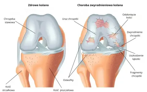 Porównanie zdrowego kolana z kolanem dotkniętym gonartrozą. Widać uszkodzenia chrząstki, odsłonięte kości i osteofity.
