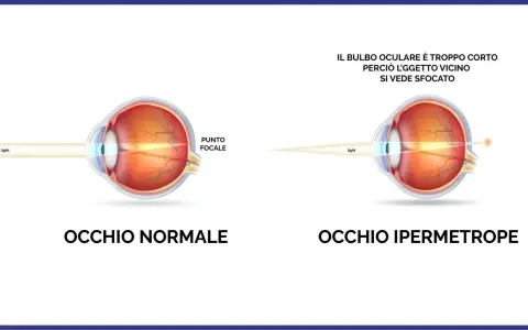Confronto tra occhio normale e occhio ipermetrope: in quest'ultimo, il bulbo corto fa sì che l'oggetto vicino si veda sfocato.