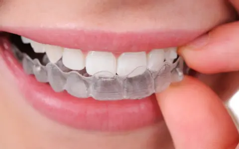 Jak naprawdę wygląda aparat na zęby? Od metalu po niewidoczne