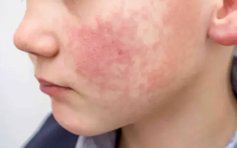 Rostro de niño con erupción roja y escamosa, síntoma del virus del tortazo.