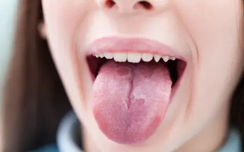 Usta otwarte, język wysunięty, z widocznym zaczerwienieniem sugerującym pieczenie języka.