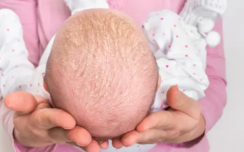 Babykopf mit Schuppen, Anzeichen von trockener Kopfhaut bei Babys.