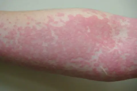 Brazo con erupción cutánea de ronchas rosadas y elevadas, algunas pequeñas y dispersas, otras formando parches más grandes.