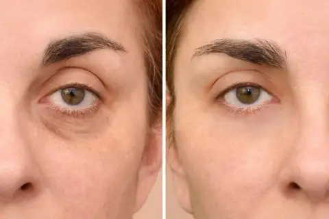 Comparación antes y después: cómo quitar las ojeras. El ojo izquierdo muestra ojeras marcadas y piel flácida, mientras que el derecho luce más liso y rejuvenecido.