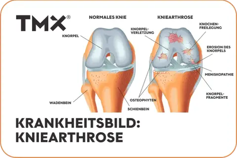 Vergleich von gesundem Knie und Kniearthrose. Die Darstellung zeigt Knorpelverschleiß, Erosionen und Knochenreizungen – eine mögliche "wunderwaffe gegen arthrose knie" könnte hier Abhilfe schaffen.