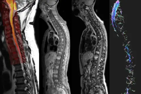 Kolorowy rezonans magnetyczny kręgosłupa lędźwiowo-krzyżowego pokazuje zmiany. Obok klasyczne obrazy MRI kręgosłupa i wizualizacja włókien nerwowych.
