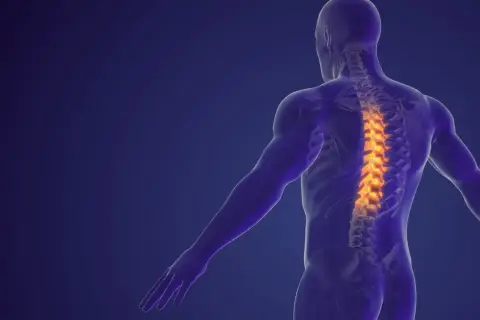 Anatomical model of a human torso showing a spine with highlighted areas indicating dyskopatia wielopoziomowa.