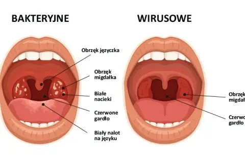 Jakie leki na anginę ropną? Skuteczne antybiotyki i porady zdrowotne