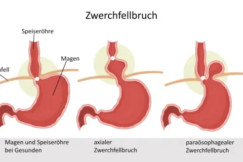 Illustrationen zeigen Zwerchfellbruch-Arten. Symptome bei Frauen können vielfältig sein, hier axialer und paraösophagealer Bruch.