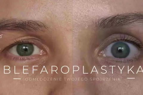 Przed i po zabiegu blefaroplastyki. Widoczna poprawa wyglądu powiek, odmłodzenie spojrzenia.