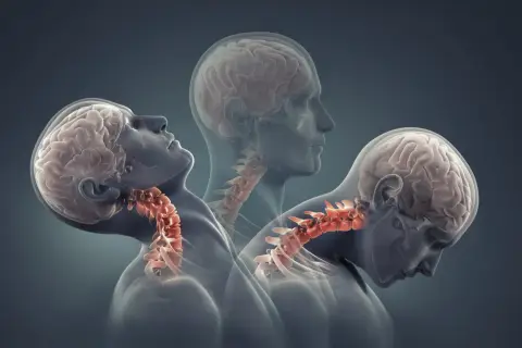 Trzy sylwetki ukazujące ruch głowy i szyi, ilustrujące mechanizm urazu whiplash.