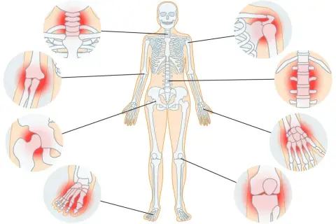 Menschliches Skelett mit hervorgehobenen Gelenken, die Schmerzen zeigen. Arthrose heilen ist so einfach, wenn man die betroffenen Stellen kennt.