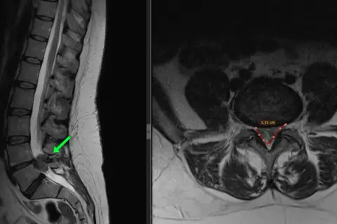 MRI kręgosłupa lędźwiowego z widoczną przepukliną krążka międzykręgowego, zaznaczoną zieloną strzałką. Widoczny pomiar 1.31 cm.