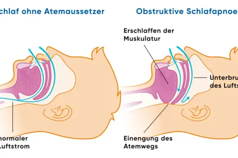 Vergleich: normaler Luftstrom vs. obstruktive Schlafapnoe mit Atemwegseinengung. Dies kann zu Herzrasen führen.
