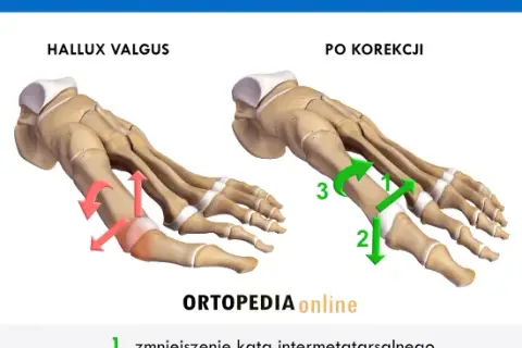 Operacja haluksa: Metody, rekonwalescencja, koszty wszystko co musisz wiedzieć