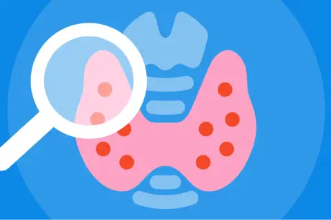 Ilustracja przedstawia tarczycę pod lupą, sugerującą diagnostykę subklinicznej niedoczynności tarczycy.