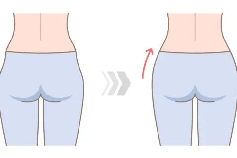 Ilustración de una mujer mostrando la reducción de los hip dips.