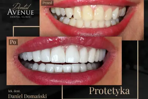 Przed i po: metamorfoza uśmiechu dzięki licówkom. Sprawdź, jaka jest licówki cena i odmień swój wygląd!
