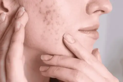 Manos tocando el rostro, mostrando marcas de espinillas y cicatrices en la piel.