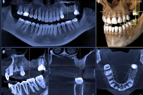 Tomografia CBCT prezentuje obraz zębów i szczęki w przekrojach: panoramicznym, osiowym, strzałkowym i poprzecznym.