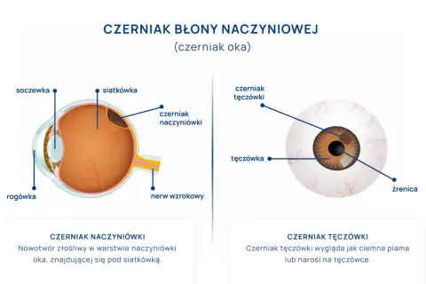 Ilustracje przedstawiają czerniaka oka: czerniak naczyniówki pod siatkówką i czerniak tęczówki. Ból oka może być objawem.