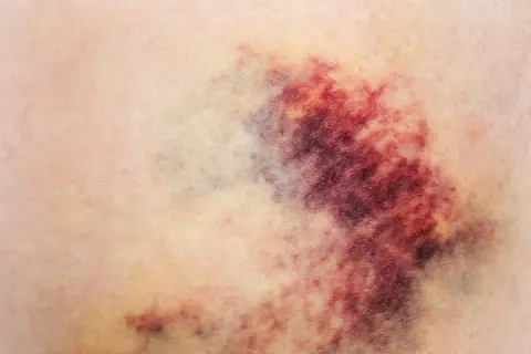 Siniak na skórze, z odcieniami czerwieni, fioletu i żółci. Wygląda jak ślad po uderzeniu, może nawet exacyl.