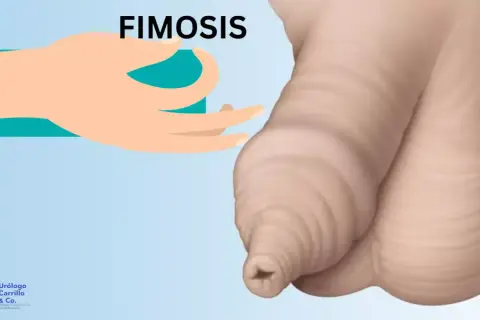 Ilustración de fimosis, una condición que puede afectar a niños. Se muestra un prepucio retraído y la acumulación de esmegma.