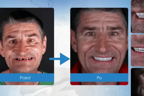 Uśmiech przed i po: brak zębów vs. pełny, piękny uśmiech po zabiegu implantacji.