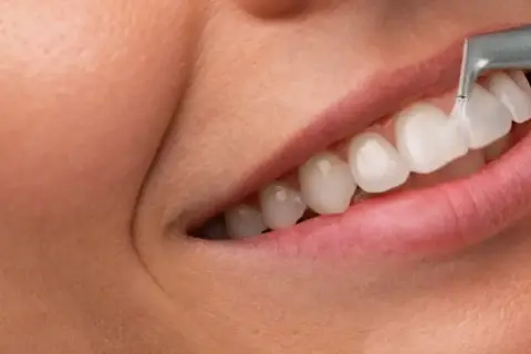 Profesjonalna higienizacja zębów. Dentysta czyści białe zęby strumieniem wody i powietrza, zapewniając idealny uśmiech.
