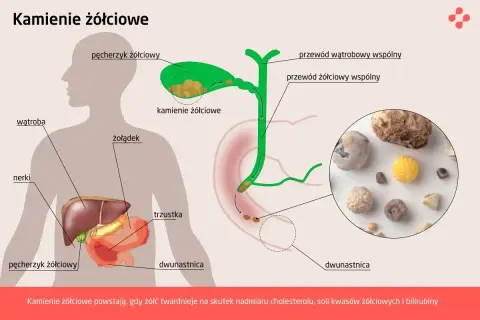 Ilustracja przedstawia anatomię człowieka z zaznaczonym pęcherzykiem żółciowym, gdzie widoczne są kamienie żółciowe. Pokazuje też drogi żółciowe i narządy trawienne.