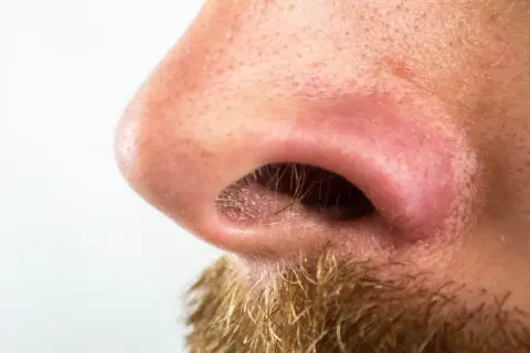 Primer plano de una nariz con poros visibles y algunas espinillas negras. Se aprecia vello facial en la parte inferior.