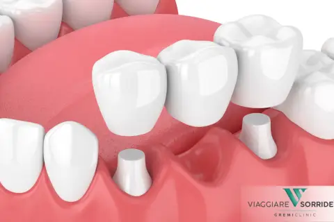Dettaglio di una capsula devitalizzazione dente, con ponti dentali che coprono monconi preparati.