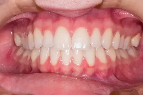 Gengive rosse e gonfie, con segni di sanguinamento gengive quando preoccuparsi. Denti bianchi e allineati.