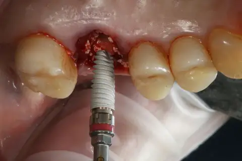 Impianto dentale in corso. Evitare di fumare dopo l'intervento per favorire la guarigione.