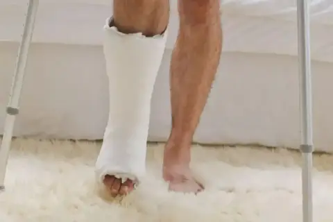 Osoba z gipsem na nodze i kulami, przygotowuje się do ćwiczeń, jak samemu rehabilitować stopę po złamaniu.