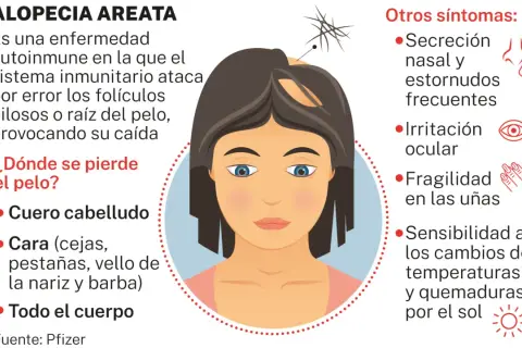 Ilustración de una mujer con alopecia areata, mostrando la pérdida de cabello en el cuero cabelludo y otros síntomas.