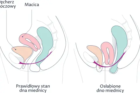 Porównanie prawidłowego i osłabionego dna miednicy z widoczną macicą.