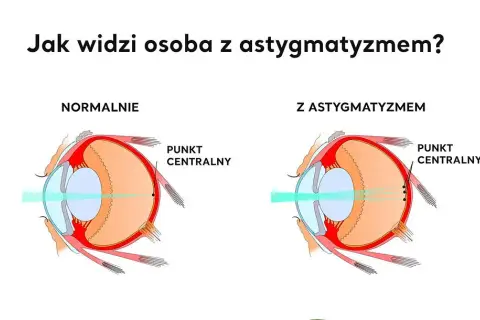 Jakie są wady wzroku? Poznaj objawy i skuteczne leczenie