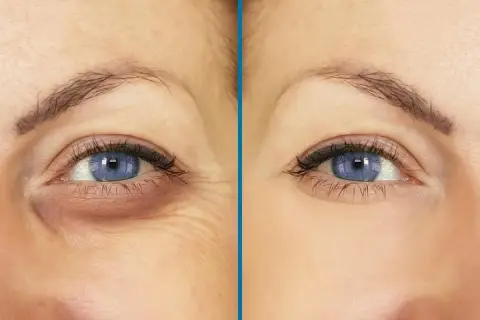 Ojos con ojeras hundidas y arrugas antes y después de un tratamiento.