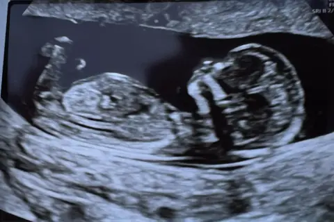 USG płodu, widać główkę i tułów. To zdjęcie z okresu, w ktorym tygodniu widac plec.