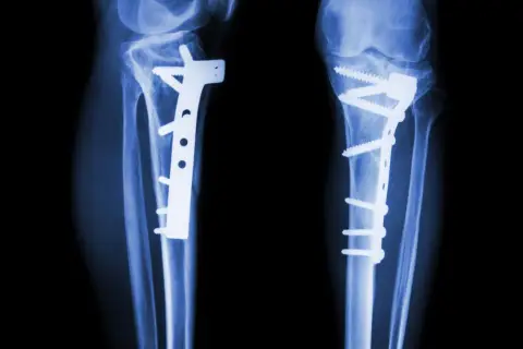 Rentgen nóg po zabiegu osteotomii. Widoczne zespolenia kości płytami i śrubami.