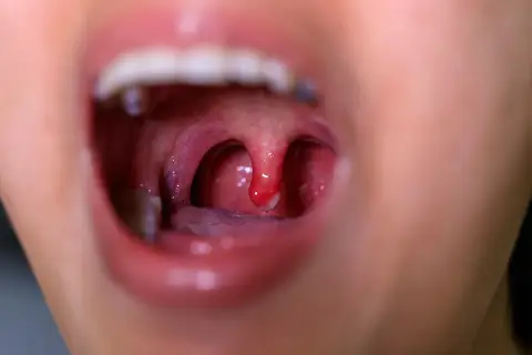 Gola arrossata con tonsille gonfie e una piccola lesione, indicativa di mucosite orale.