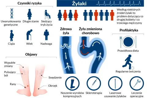 Widoczne nogi z widocznymi pajęczynami naczyniowymi. Lupa powiększa fragment skóry, uwidaczniając żylaki.