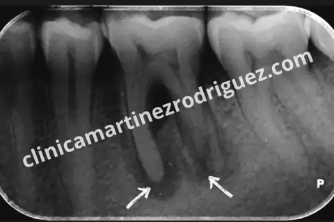 Radiografía dental muestra una posible infección endodoncia con áreas radiolúcidas en ápices radiculares, señaladas por flechas.