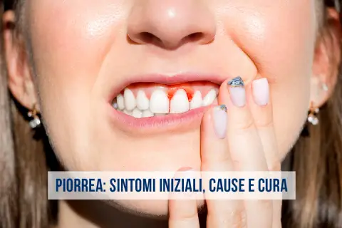 Gengive sanguinanti, un sintomo iniziale della piorrea. Scopri le cause e come curarla.