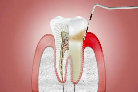 Przekrój zęba z widocznymi uszkodzeniami dziąseł, wskazującymi na zapalenie dziąseł (gingivitis). Narzędzie dentystyczne bada stan zapalny.